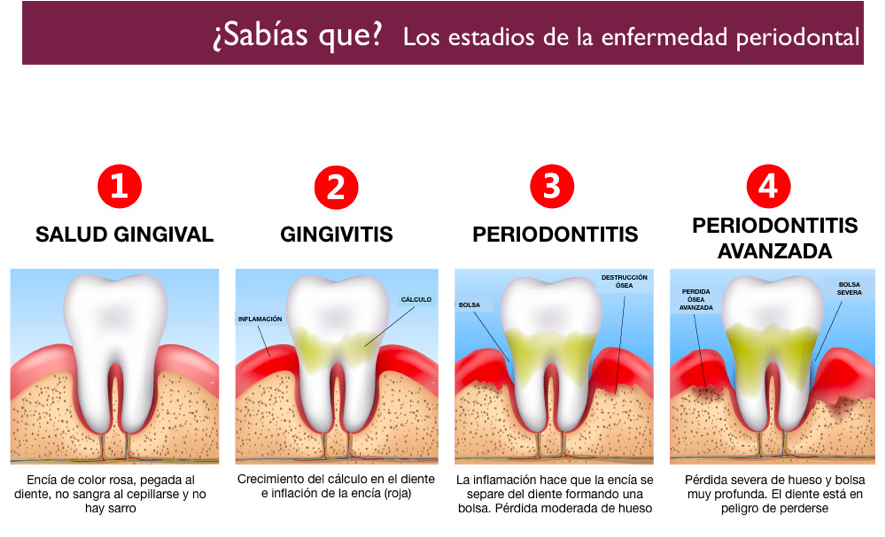 Encías inflamadas