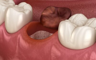 Alveolitis dental