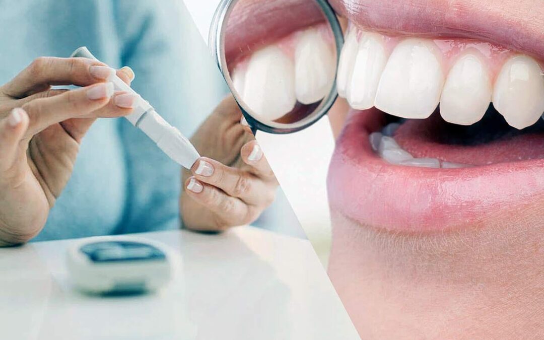 Diabetes y salud bucal: una relación más estrecha de lo que imaginas