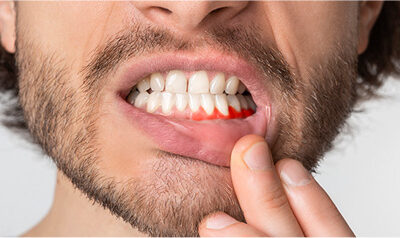 ¿Por qué sangran las encías? Causas y soluciones