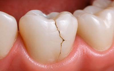 ¿Por qué se rompen los dientes? Causas, prevención y qué hacer si te ocurre